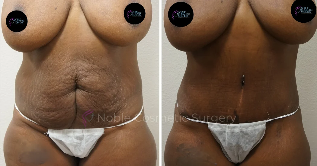 TUMMY-TUCK-CASE-00044 | Before and After Abdominoplasty 1