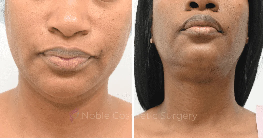 SUBMENTAL-LIPOSUCTION-CASE-12998 | Before and After Chin Liposuction 1