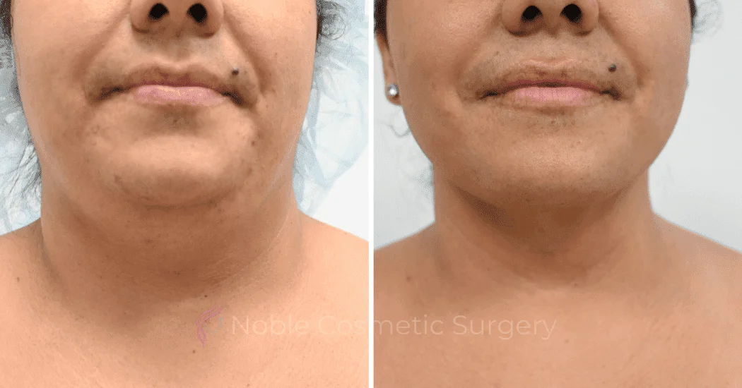 SUBMENTAL-LIPOSUCTION-CASE-12466 | Before and After Chin Liposuction 1