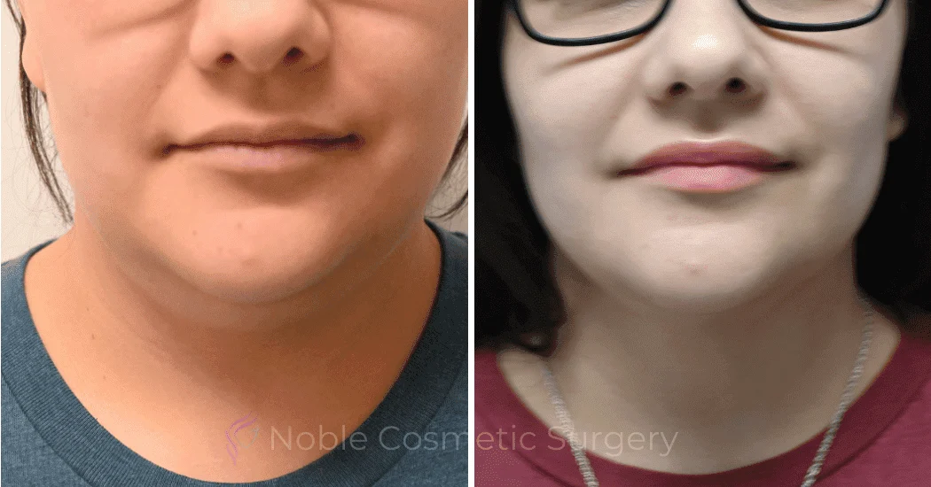 SUBMENTAL-LIPOSUCTION-CASE-10173 | Before and After Chin Liposuction 1