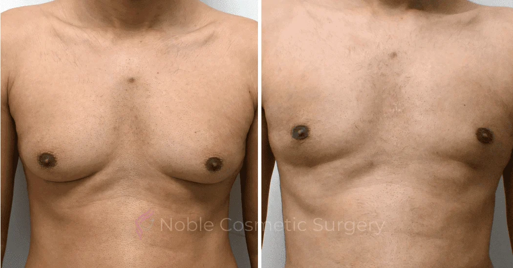 GYNECOMASTIA-CASE-10707 | Before and After Gynecomastia 1