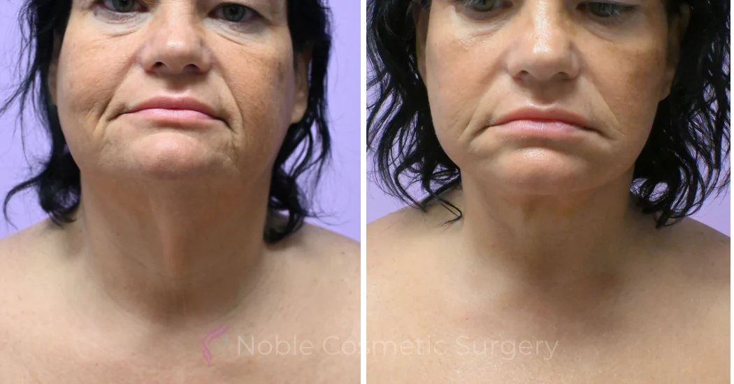 Case--5722 | Before and After Facelift 1