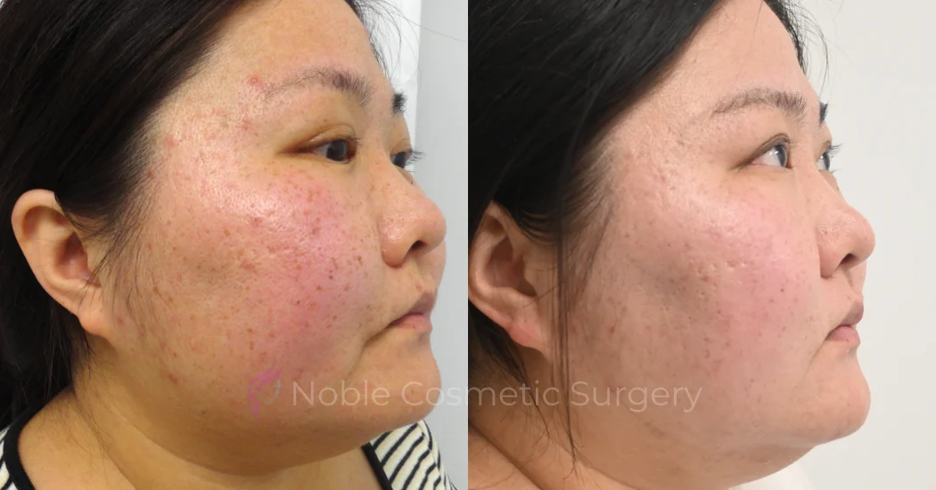 PICO-LASER-CASE-00006 | Before and After Pico Skin Rejuvenation 1