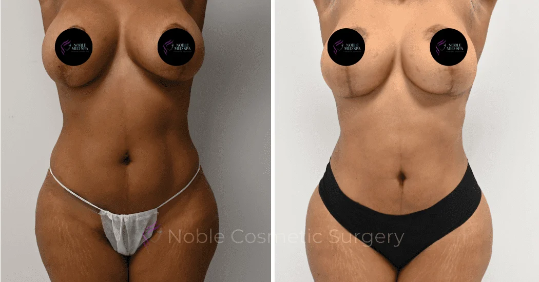 MOMMY-MAKEOVER-CASE-16458 | Before and After Mommy Makeover 1