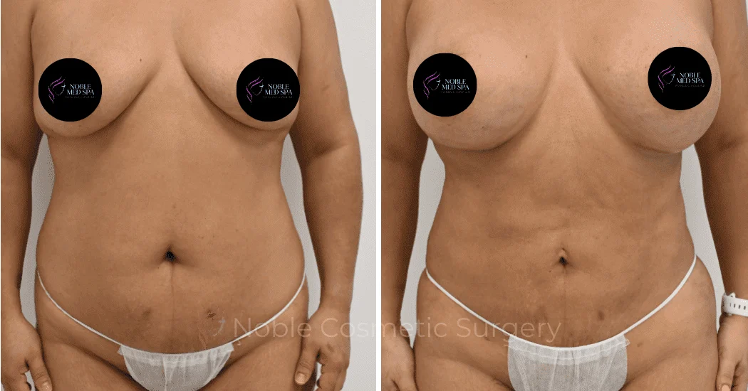 MOMMY-MAKEOVER-CASE-12466 | Before and After Mommy Makeover 1