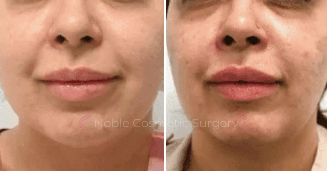 DERMAL-FILLERS-CASE-00259 | Before and After Dermal Fillers 1