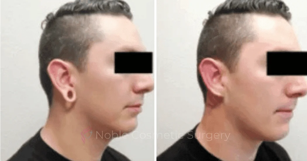 Earlobe-Repair-Case-20254 | Before and After Earlobe Repair 2