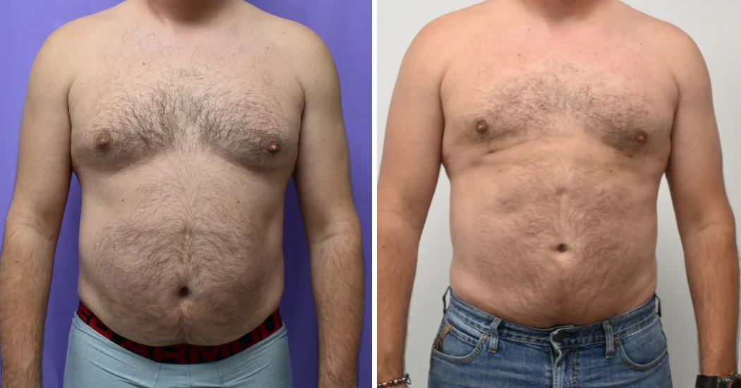 Case--13711 | Before and After Male Liposuction 1