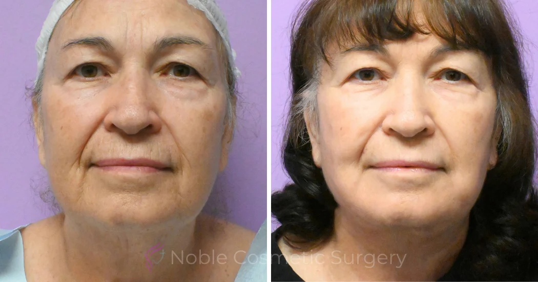 Case--20618 | Before and After Facelift 1