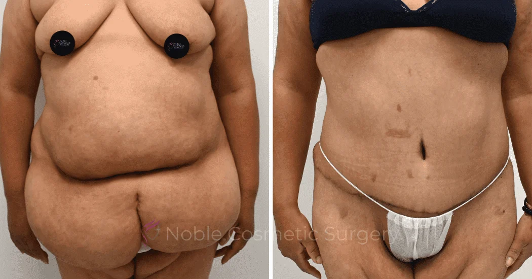 TUMMY-TUCK-CASE-12513 | Before and After Abdominoplasty 1