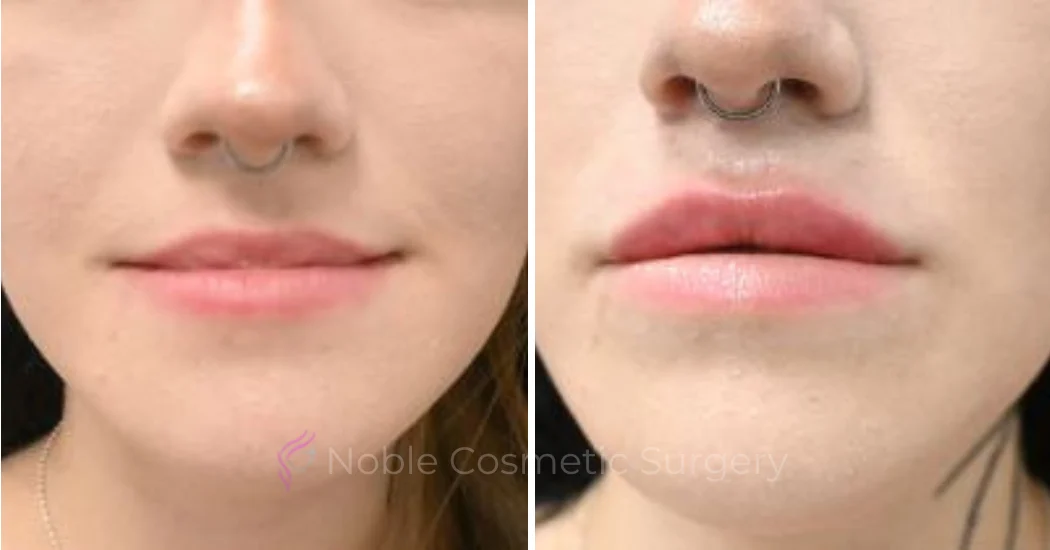 DERMAL-FILLERS-CASE-00265 | Before and After Dermal Fillers 1