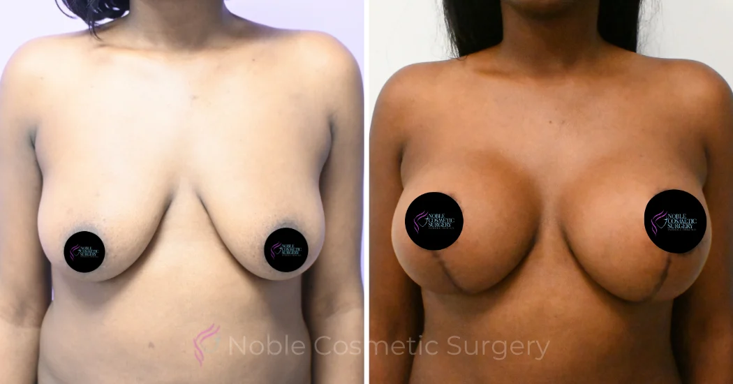 Case--5094 | Before and After Breast Augmentation with Lift 1