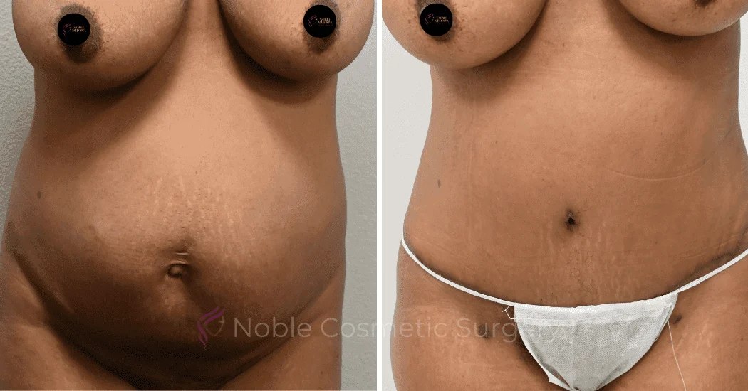TUMMY-TUCK-CASE-14407 | Before and After Abdominoplasty 1