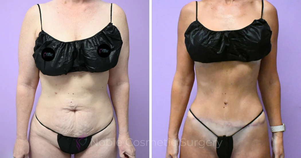 -20309 | Before and After Abdominoplasty 1