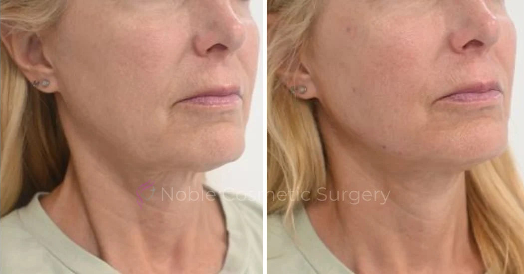 RF-MICRONEEDLING-CASE-00050 | Before and After RF Microneedling 1