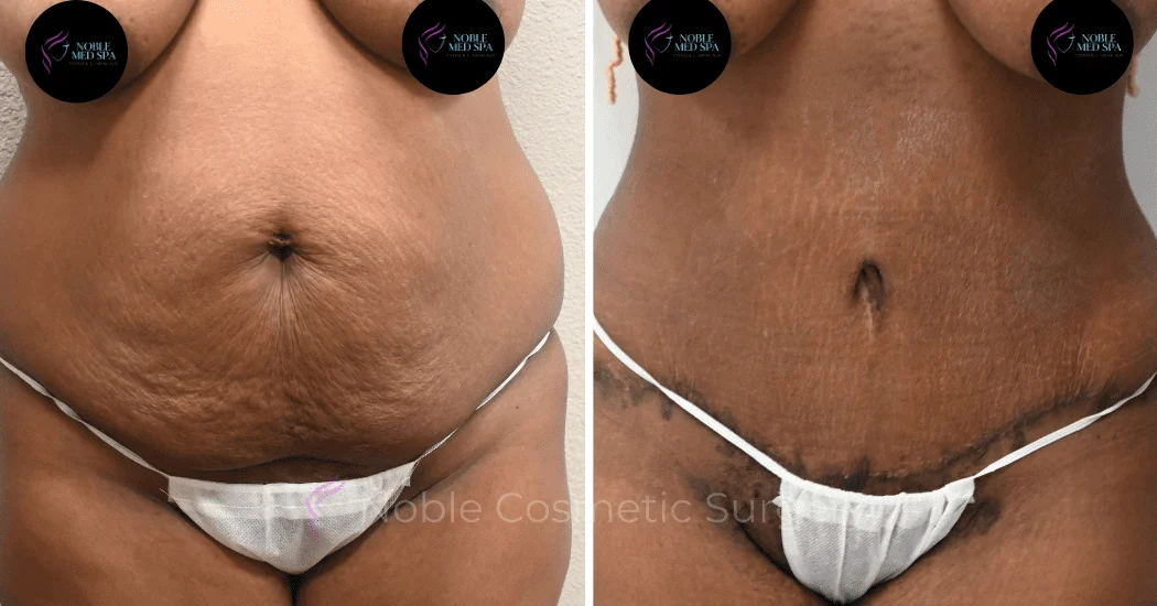 TUMMY-TUCK-CASE-13859 | Before and After Abdominoplasty 1