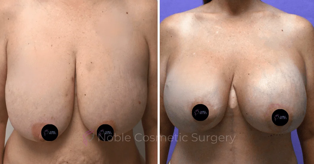 BREAST-AUGMENTATION-WITH-LIFT-CASE-10275 | Before and After Breast Augmentation with Lift 1