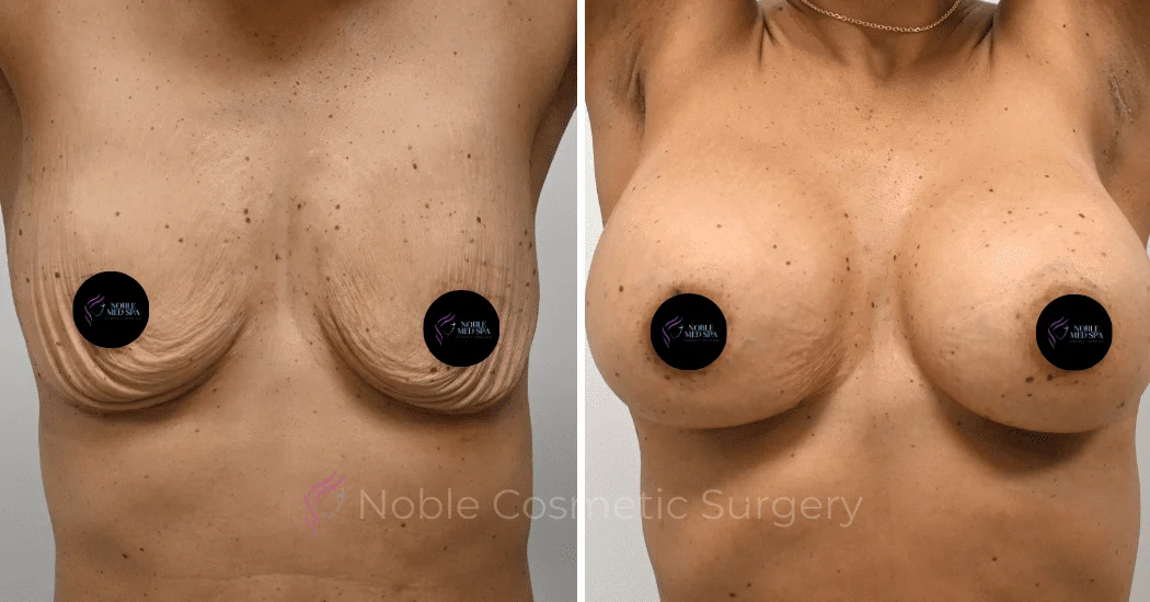 BREAST-AUGMENTATION-CASE-13021 | Before and After Breast Augmentation 1