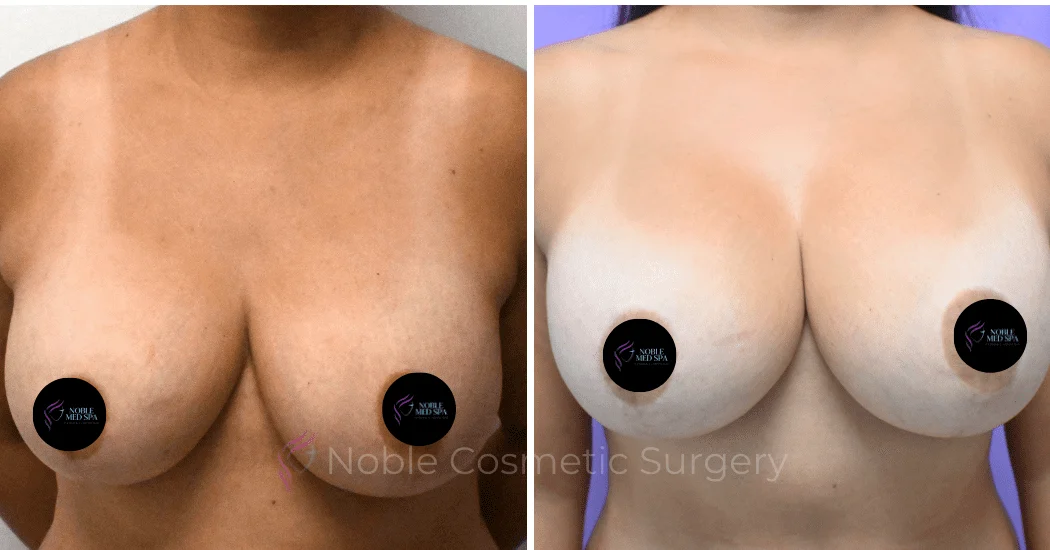 BREAST-AUGMENTATION--CASE-00310 | Before and After Breast Augmentation 1