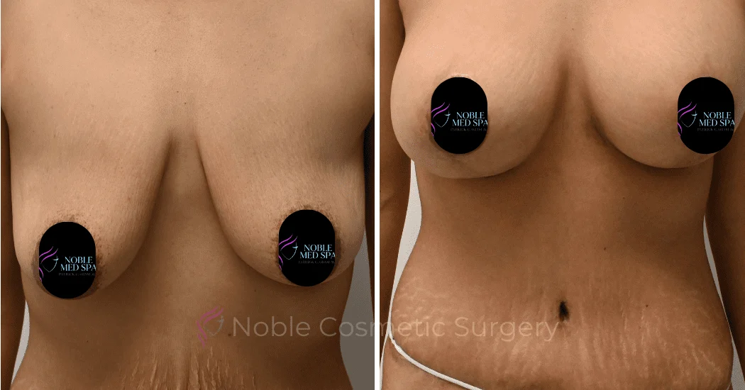 BREAST-AUGMENTATION-WITH-LIFT-CASE-10931 | Before and After Breast Augmentation with Lift 1