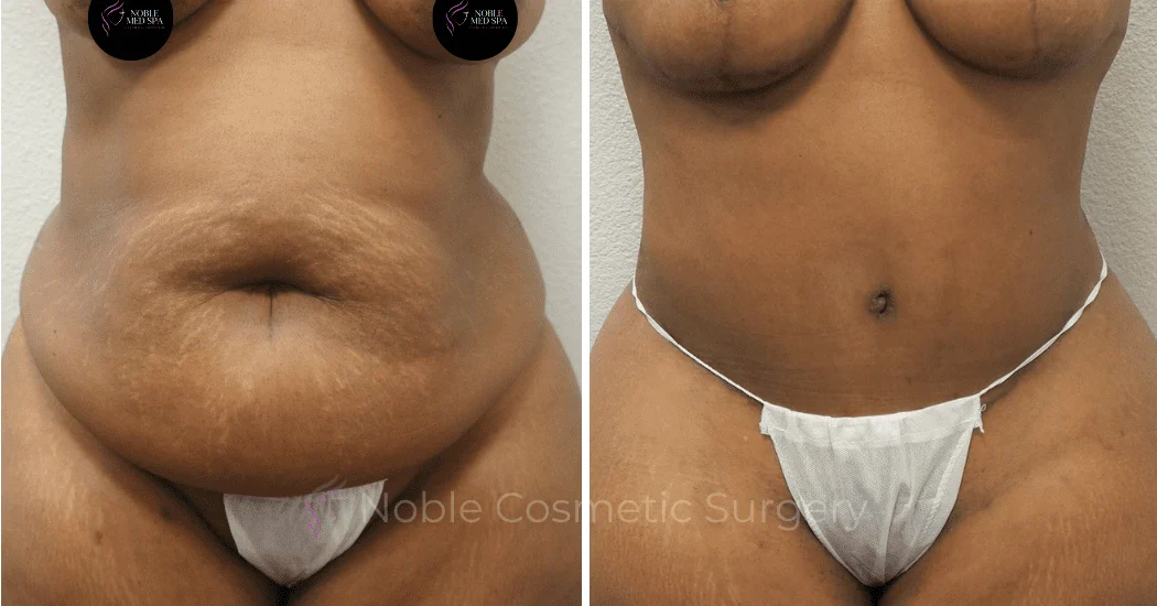 TUMMY-TUCK-CASE-00302 | Before and After Abdominoplasty 1
