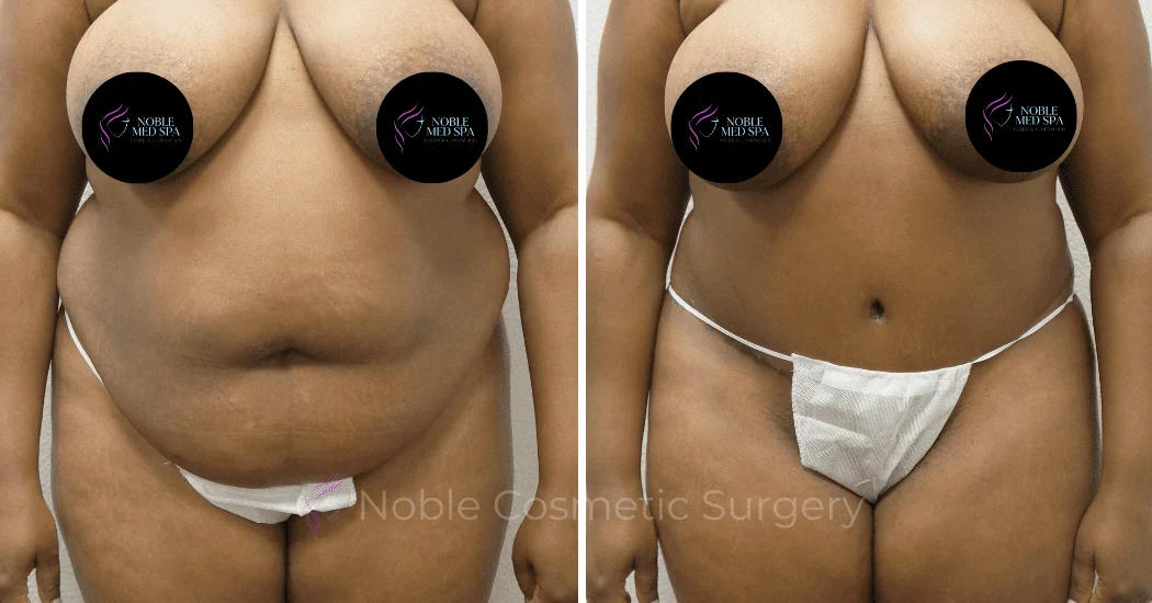 TUMMY-TUCK-CASE-00307 | Before and After Abdominoplasty 1