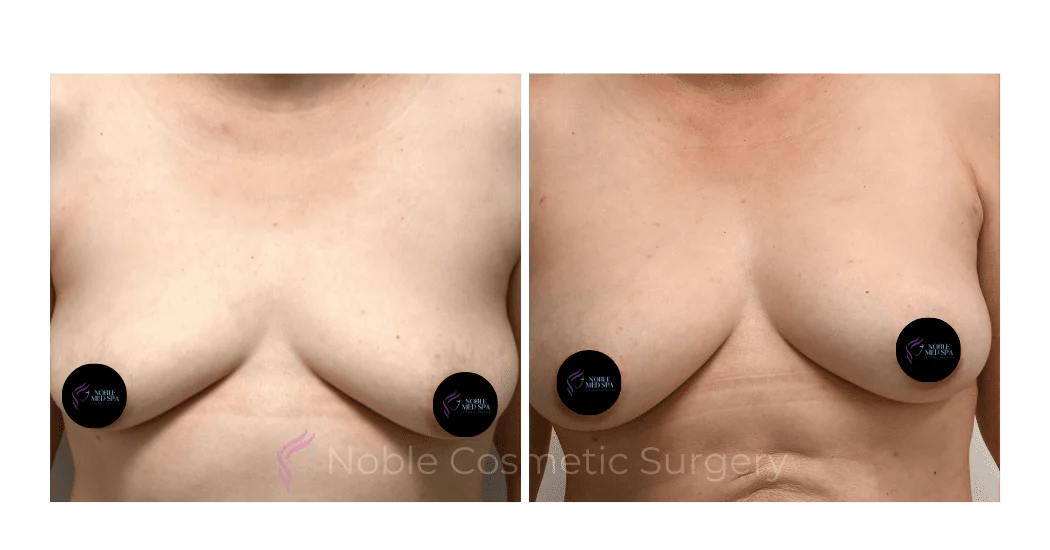 BREAST-AUGUMENTATION-WITH-FAT-TRANSFER-CASE-00260 | Before and After Breast Augmentation 1