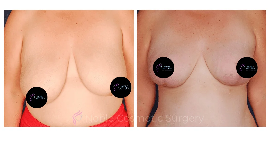 BREAST-REDUCTION-CASE-00224 | Before and After Breast Reduction 1