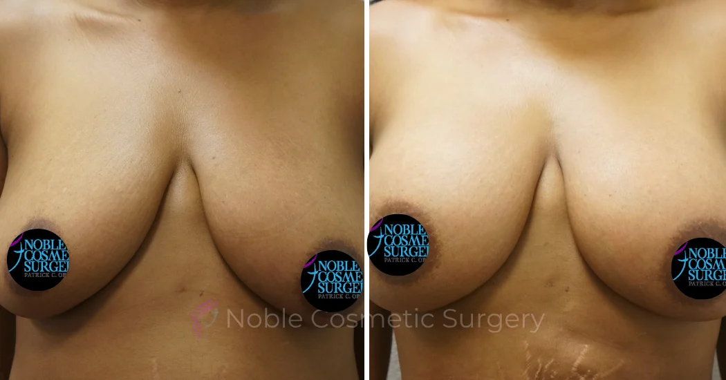 BREAST-AUGMENTATION--WITH-FAT-TRANSFER--CASE-00268 | Before and After Breast Augmentation 1