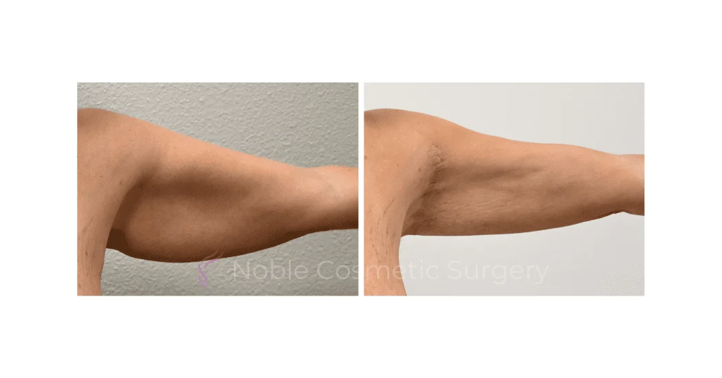 ARM-LIFT-CASE-00257 | Before and After Brachioplasty 1