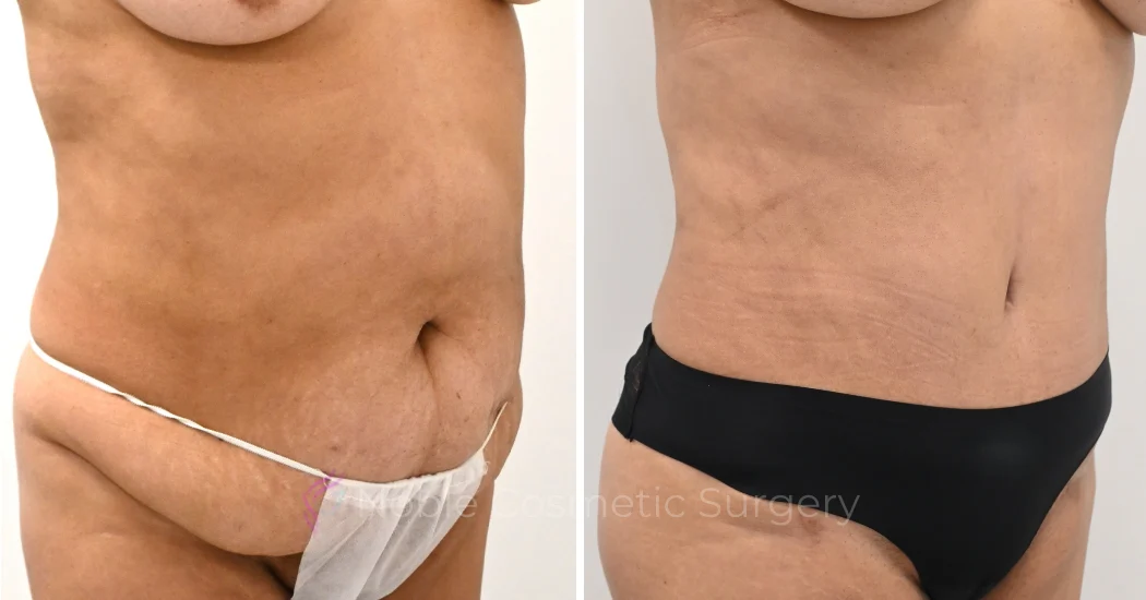 TUMMY-TUCK-CASE-00324 | Before and After Abdominoplasty 2