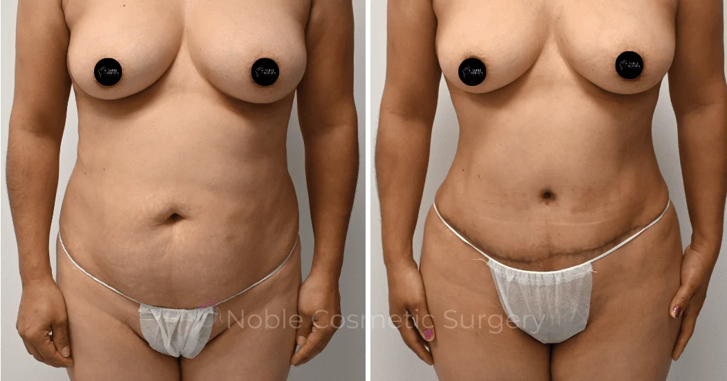TUMMY-TUCK-CASE-00313 | Before and After Abdominoplasty 1