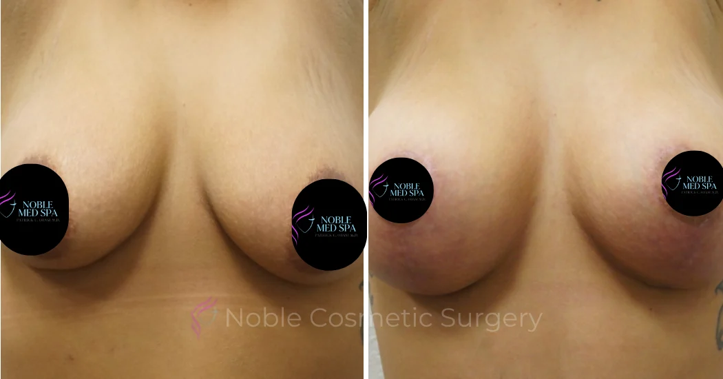 BREAST-AUGMENTATION--WITH-LIFT--CASE-00309 | Before and After Breast Augmentation with Lift 1