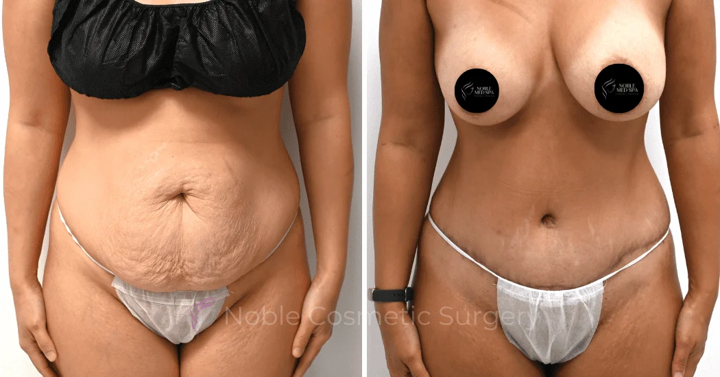 TUMMY-TUCK-CASE-00316 | Before and After Abdominoplasty 1