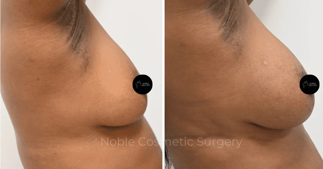 BREAST-AUGMENTATION-WITH-FAT-TRANSFER-CASE-00261 | Before and After Breast Augmentation 1