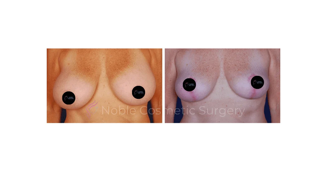 BREAST-LIFT-CASE-00500 | Before and After Breast Lift 1