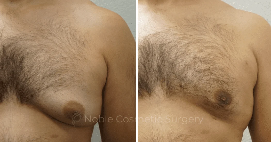 GYNECOMASTIA--CASE-16730 | Before and After Gynecomastia 1