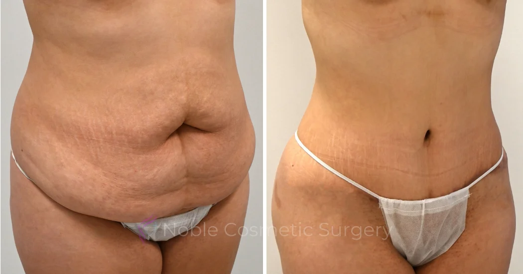 TUMMY-TUCK-CASE-00325 | Before and After Abdominoplasty 1