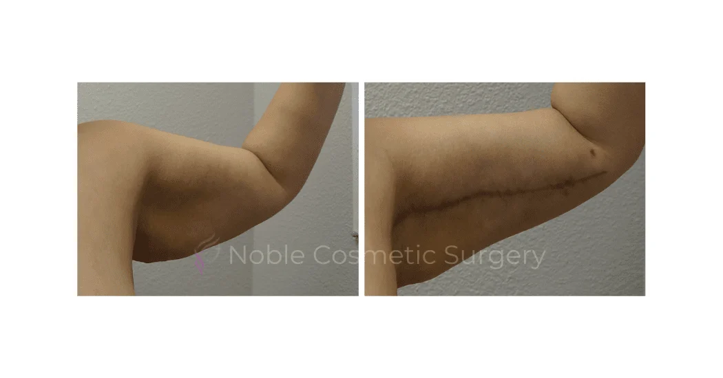 ARM-LIFT-CASE-17203 | Before and After Brachioplasty 1