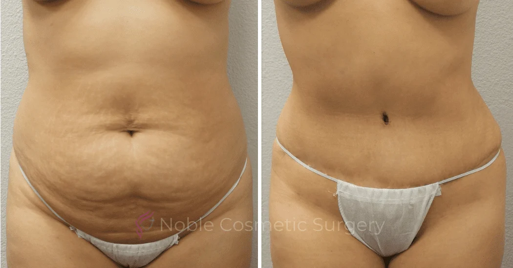 TUMMY-TUCK-CASE-00304 | Before and After Abdominoplasty 1