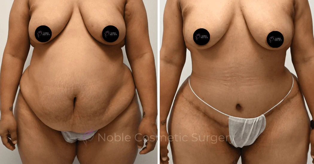 TUMMY-TUCK-CASE-00310 | Before and After Abdominoplasty 1