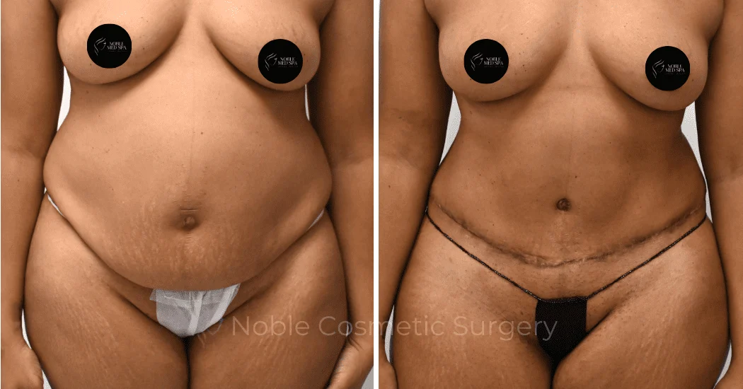 TUMMY-TUCK-CASE-00312 | Before and After Abdominoplasty 1