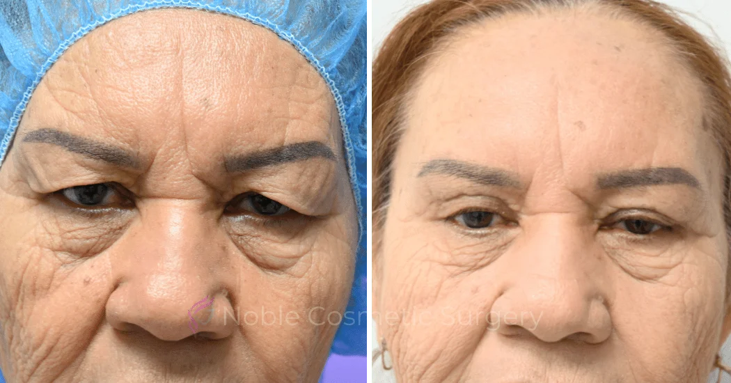 BLEPHAROPLASTY-CASE-10180 | Before and After Blepharoplasty 1