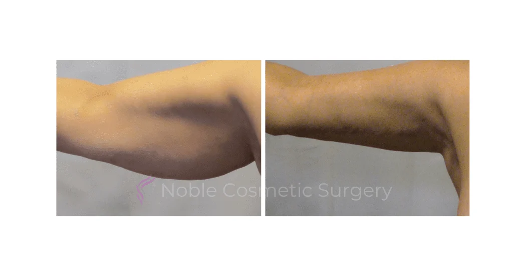 ARM-LIFT-CASE-19050 | Before and After Brachioplasty 1