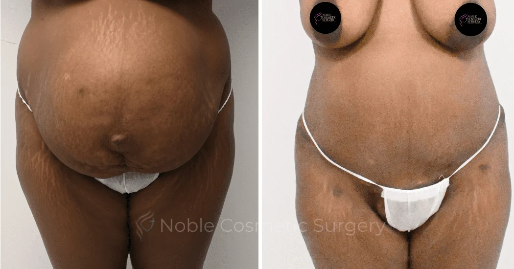 TUMMY-TUCK-CASE-11379 | Before and After Abdominoplasty 1