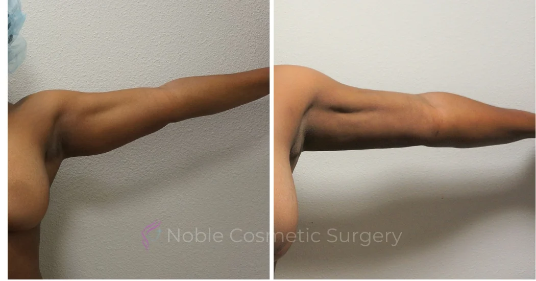 LIPOSUCTION-ARMS-CASE-00500 | Before and After Arm Liposuction 1