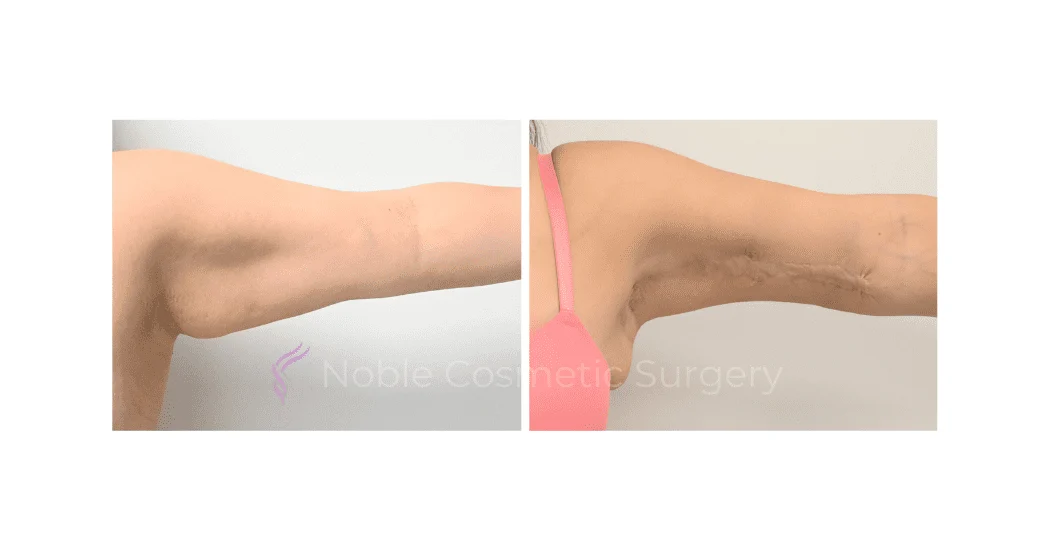 ARM-LIFT-CASE-15380 | Before and After Brachioplasty 1