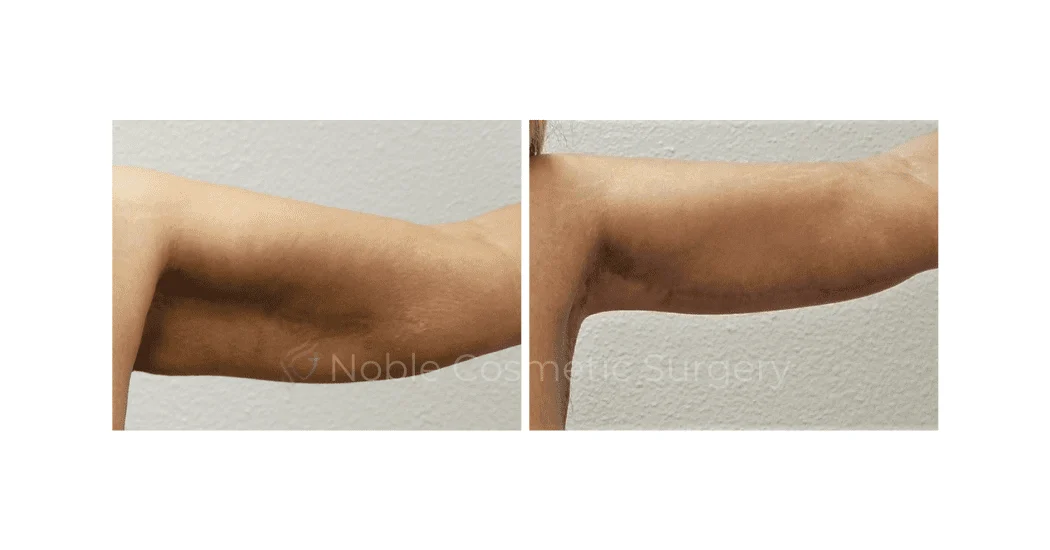 ARM-LIFT-CASE-00253 | Before and After Brachioplasty 1