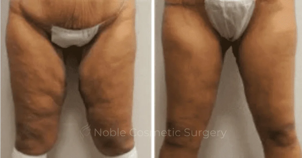 Thigh-Lift-Case-10387 | Before and After Thigh Lift 1