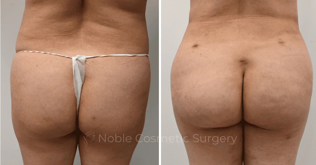 Brazilian-Butt-Lift-Case-11116 | Before and After Brazilian Butt Lift 1